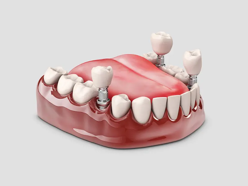 implantes-dentales-en-madrid-1